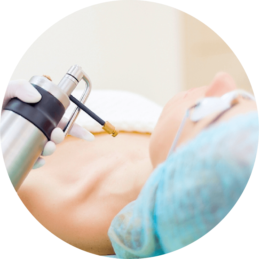 Crioterapia com nitrogênio líquido