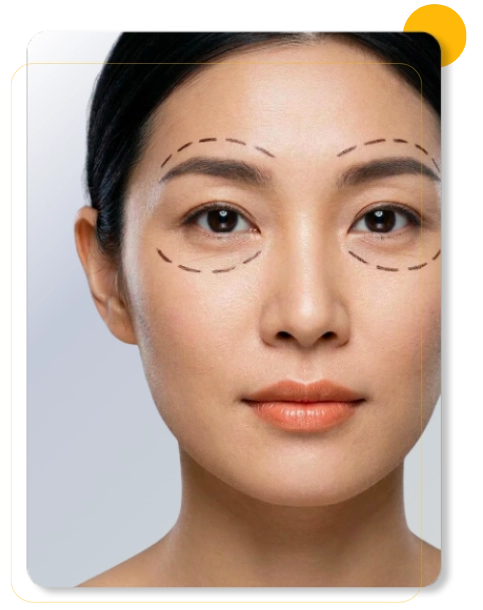 Mulher com marcações faciais para avaliação em dermatologia cirúrgica e procedimentos na região dos olhos